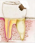 Broken tooth by cavities ˙(inlay)